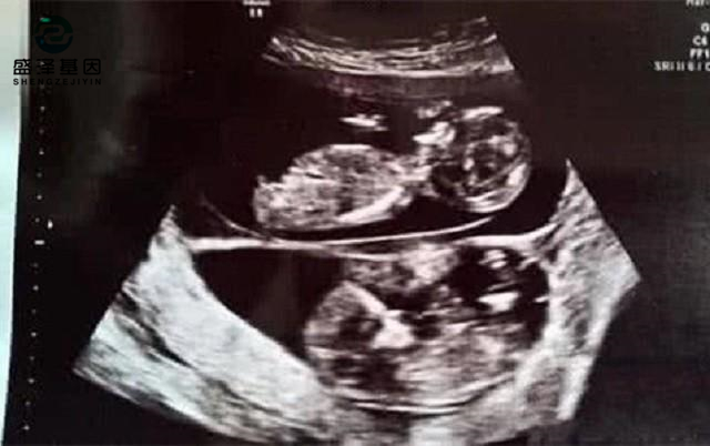 親子鑒定師講述：老公明明是無精癥，老婆卻試管嬰兒懷孕成功？