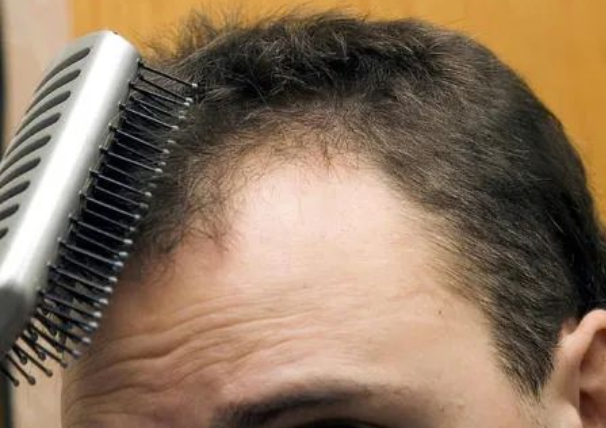 毛發(fā)可以做親子鑒定檢材嗎，怎么采集樣本才可以？